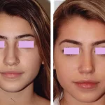 قبل و بعد جراحی بینی گوشتی
