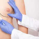 عوارض ژنیکوماستی